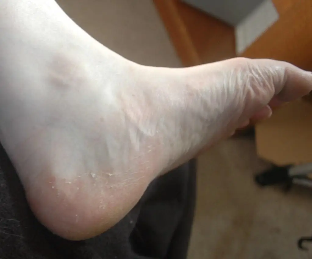 Fungal Infections: Identifying and Treating Common Foot Issues