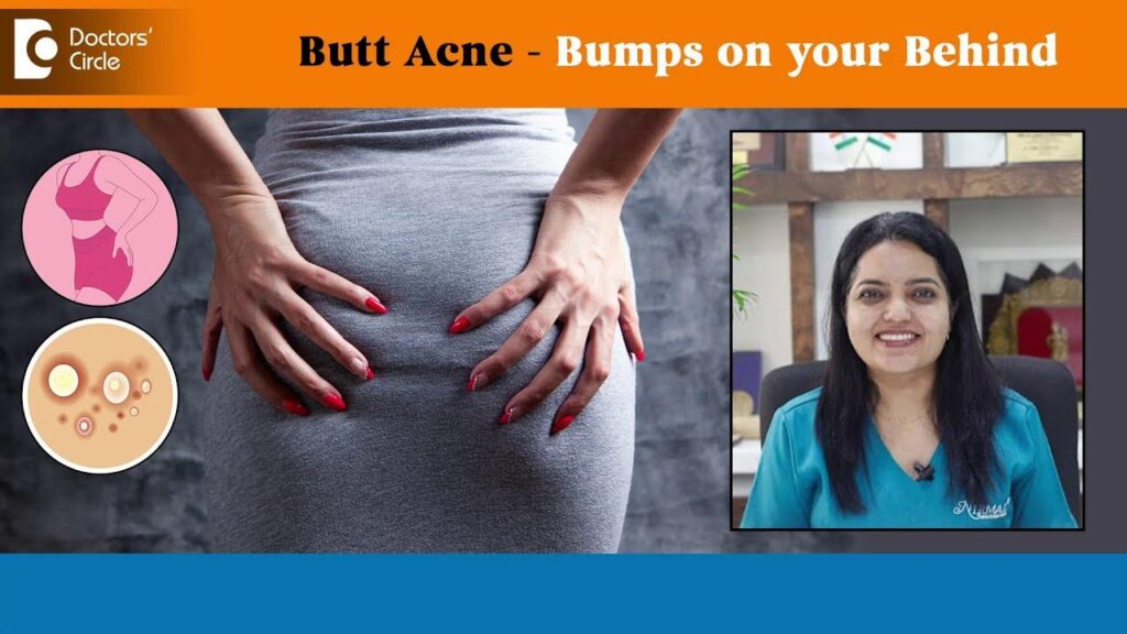 Buh-bye Butt Acne! Dr. Urmila Nischal uncovers causes & treatments