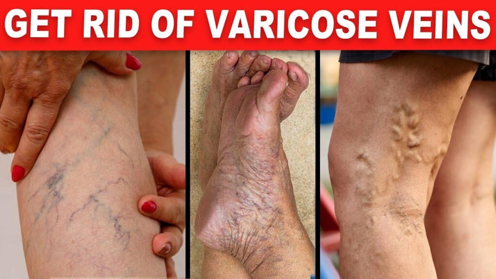 Natural Remedies for Varicose Veins: Boosting Blood Circulation