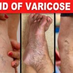 Natural Remedies for Varicose Veins: Boosting Blood Circulation