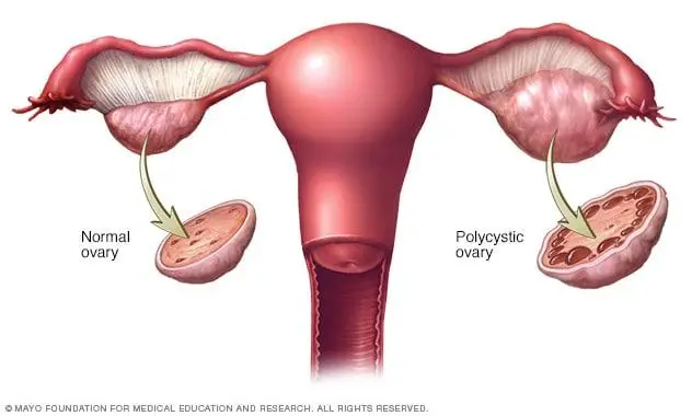 Holistic Approaches to PCOS Weight Management