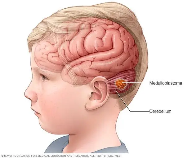 Frequent and never-ending headaches: A⁤ potential warning sign of a brain tumor