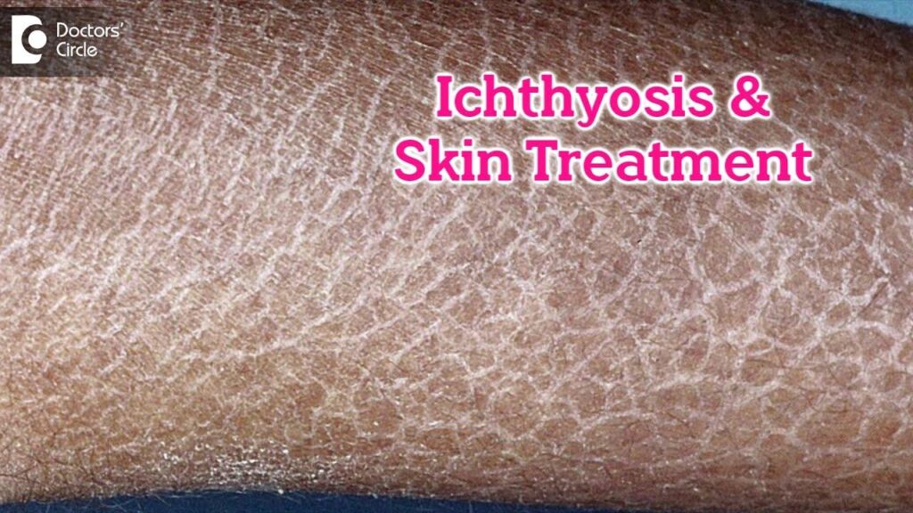 Scales of Beauty: Understanding and Treating Ichthyosis