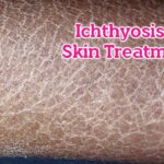 Scales of Beauty: Understanding and Treating Ichthyosis